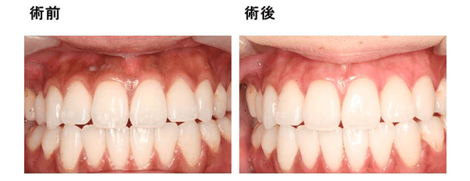 術前、術後