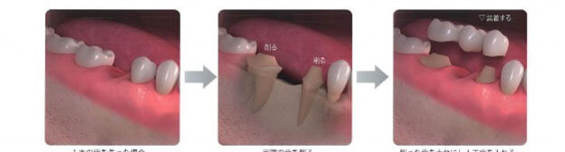 奥歯の治療方法